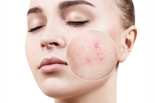 acne spots