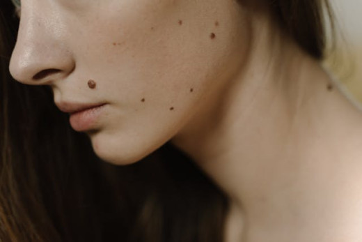 moles