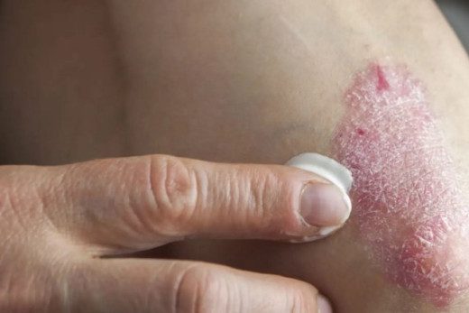Psoriasis