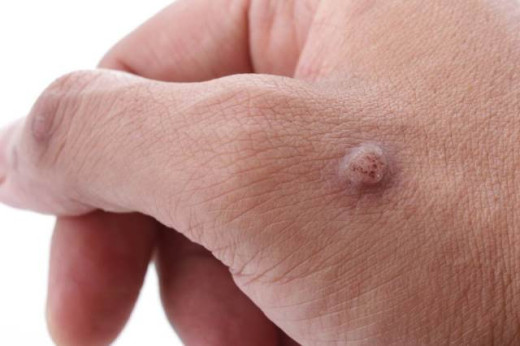 wart on hand